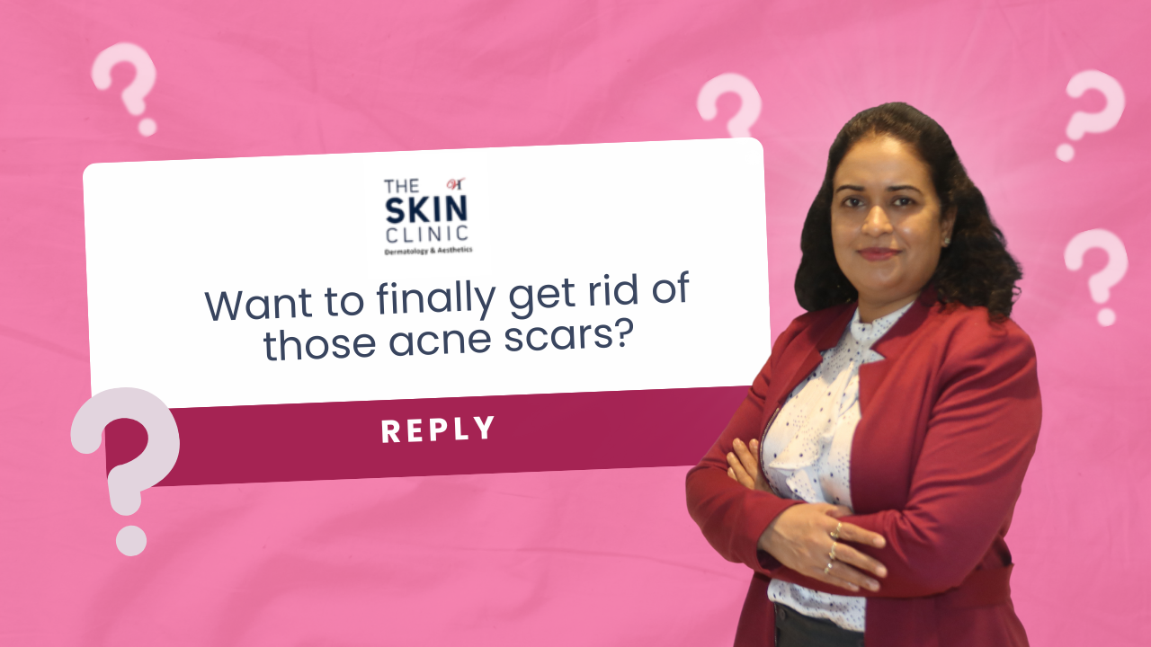 Want to finally get rid of those acne scars....