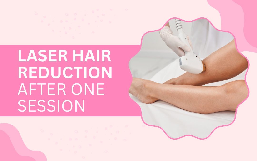 Laser Hair Reduction After One Session