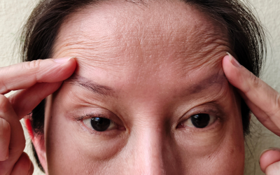 Close-up of a person pressing their temples with both hands, highlighting wrinkles on the forehead and a tense expression.