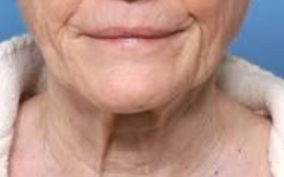 Close-up of an elderly person's lower face and neck, showing wrinkled skin and a white garment against a blue background.