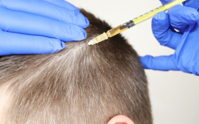Medical professional wearing blue gloves injects a syringe into a person's scalp near the crown area.