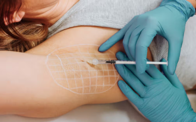 Healthcare professional with teal gloves injects into a patient’s upper arm; a white grid marks the treatment area on the skin.
