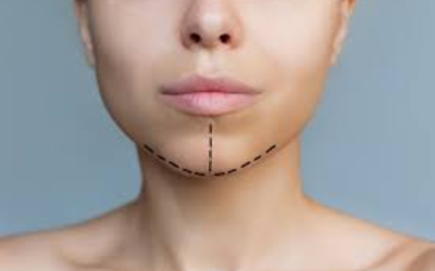 Close-up of a woman's lower face and neck with dotted surgical markings along the chin and neck, indicating planned incisions for a neck lift.