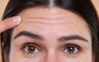 Close-up of a woman's forehead with a finger uplift showing horizontal forehead wrinkles.