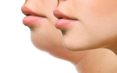 Close-up profile of a person's chin and neck, highlighting a double chin.