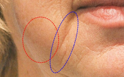 Close-up of a person's cheek with red and blue dashed ellipses marking two skin-fold areas.
