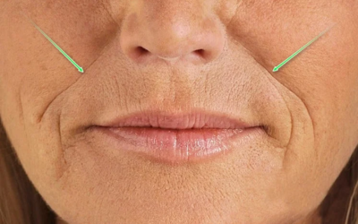 Close-up of the mouth area highlighting deep nasolabial folds and marionette lines with green arrows pointing to the wrinkles.