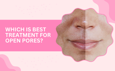 Which is Best Treatment for Open Pores?