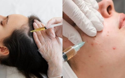 Woman receiving a cosmetic facial injection near the eyebrow while resting with eyes closed (gloved hands and syringe shown) .