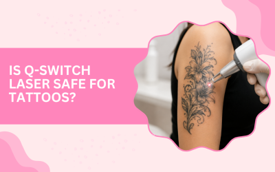 Is Q-Switch Laser Safe for Tattoos?