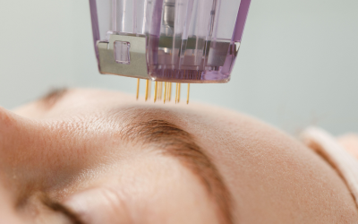 Close-up of a microneedling pen with fine needles touching a person's forehead during a facial treatment.