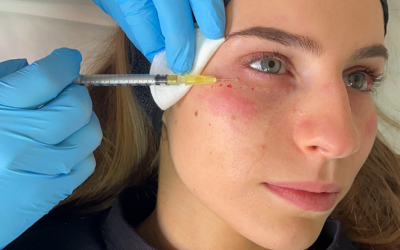Close-up of a clinician with blue gloves injecting the under-eye area of a woman's face using a syringe for a cosmetic treatment.