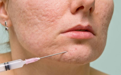 Close-up of a person’s lower face with acne scars as a syringe approaches the jawline for a cosmetic injection