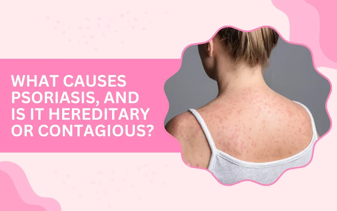 What Causes Psoriasis, and Is It Hereditary or Contagious?