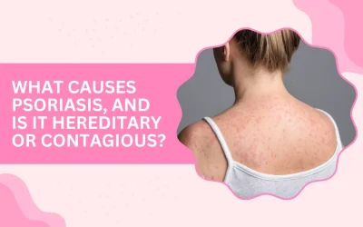 What Causes Psoriasis, and Is It Hereditary or Contagious?