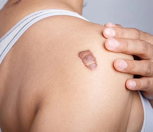H1 Keloid Treatment in Hiranandani Estate_ Thane