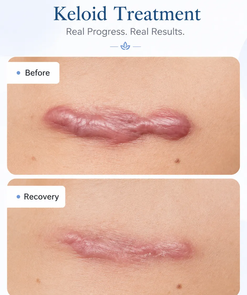 H2 Keloid Treatment Results _ Recovery Informational graphic listing signs for photo facial treatment: sun spots, redness, uneven skin tone, enlarged pores, early sun damage, and blotchy skin.