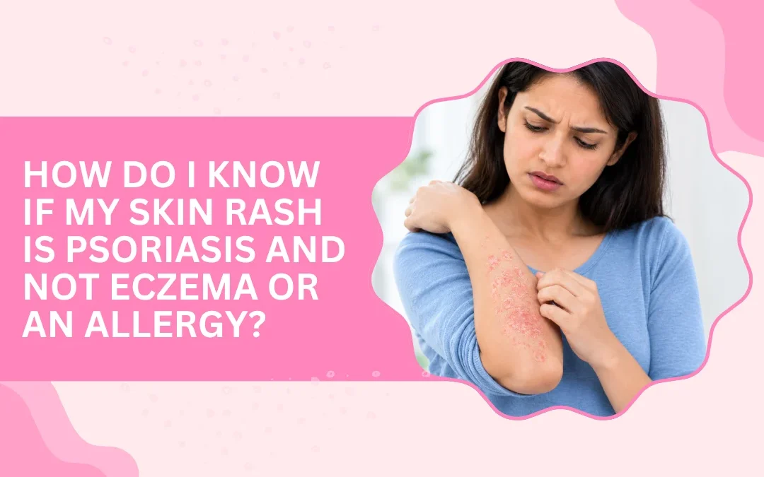 How Do I Know If My Skin Rash Is Psoriasis and Not Eczema or an Allergy