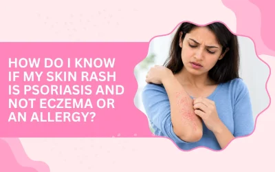 How Do I Know If My Skin Rash Is Psoriasis and Not Eczema or an Allergy?